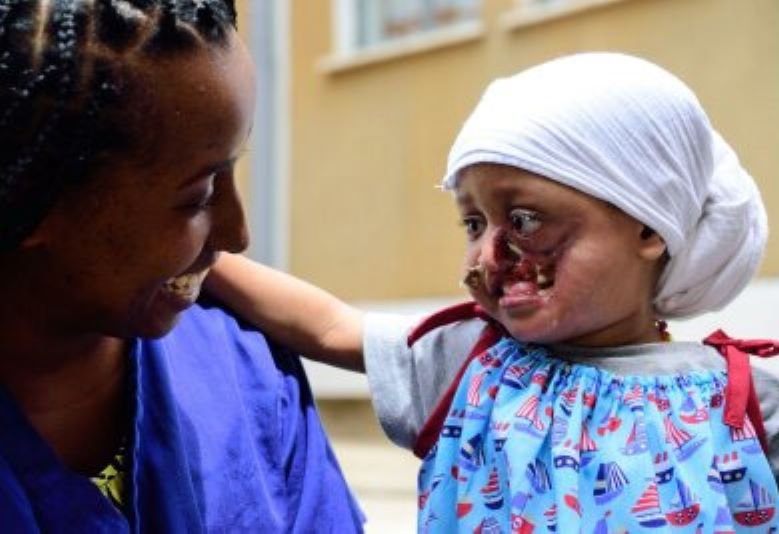 Credit: Sophie Dohnt (Facing Africa)/RSTMH Caption: America Molla (Noma patient) and Tihitna Tafete (nurse) having friendly time at Facing Africa Rehabilitation centre.