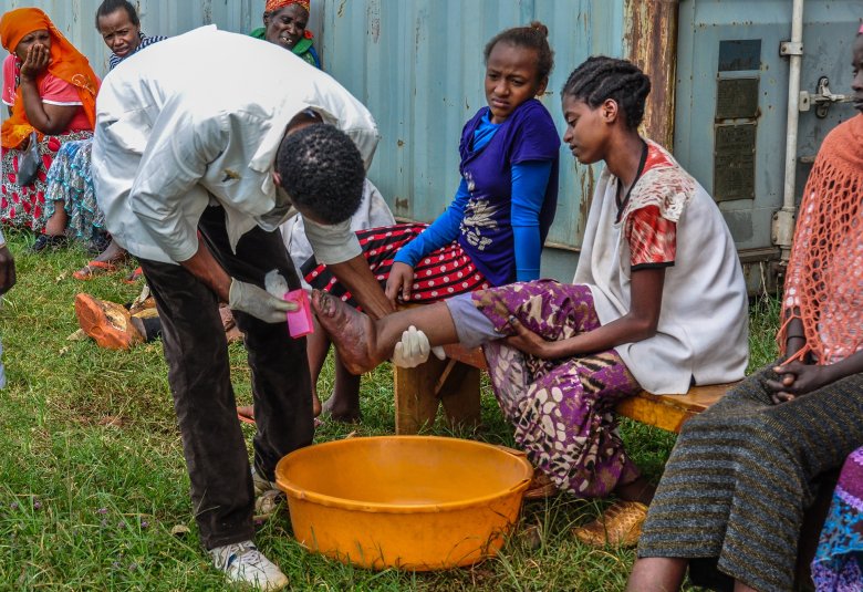 Credit: Jelle Visser   Caption: The simple treatment of podoconiosis. Tigist is successfully treated and goes back to school now. 