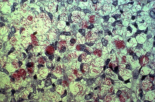 M. leprae appears red when a Ziehl-Neelsen stain is used