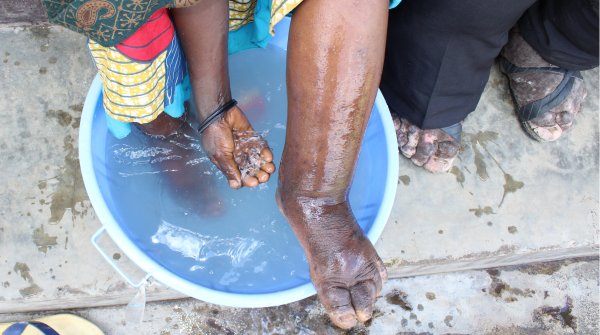 A woman with podoconiosis washes her foot. Photo: Dr Kebede Deribe